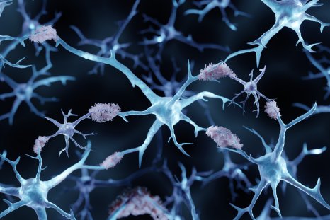 Scientists Discover Possible New Treatment for Alzheimer's