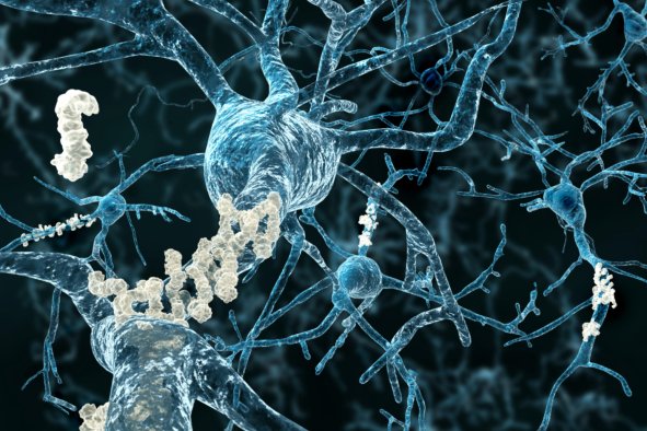 Alzheimer's Breakthrough as 'Protective' Gene May Open Up New Treatments