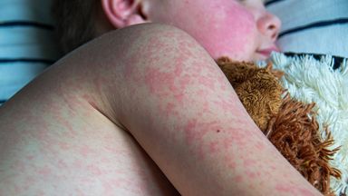 Measles cases worldwide almost double in a year - as England faces measles 'emergency'