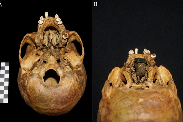 Archaeologists Discover 'Unique' Artificial Body Part in 18th Century Skull