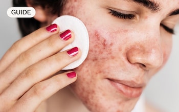 How to treat adult acne