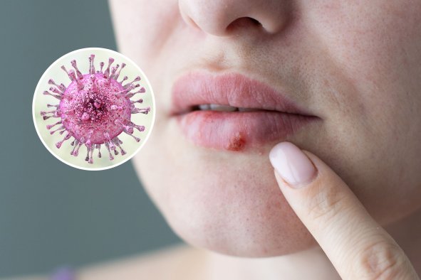 New Herpes Study Reveals 'Significant' Information