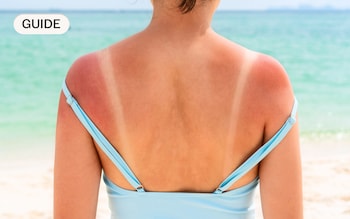 How to prevent and treat sunburn