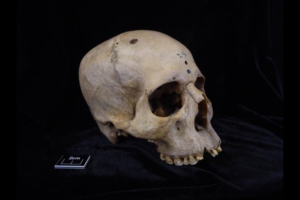 'Extraordinary' Skull Hints at Ancient Egyptian Cancer Treatment