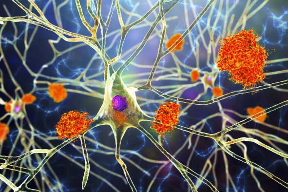 Alzheimer's Breakthrough Could Halt Progression