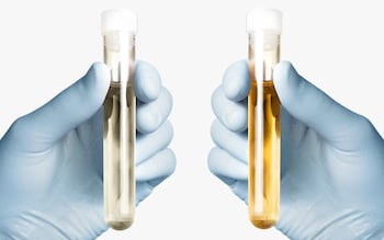 What your urine colour says about your health