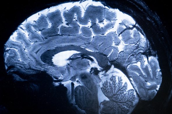 Dementia Breakthrough 'Vital' for Future Treatment: Scientists