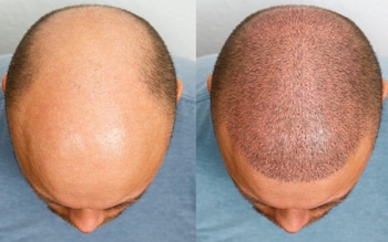 How to know if (and when) you’re going to go bald