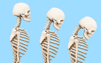 How to spot ageing bones before you fall foul of a fracture