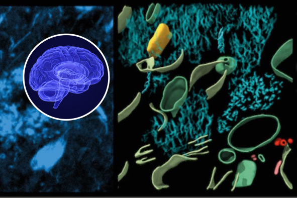 'First Glimpse' of Alzheimer's-Causing Structures Inside Brain