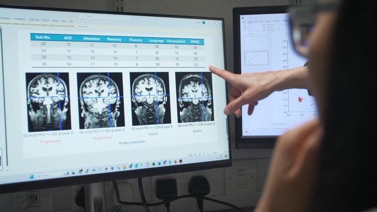 New AI tool could be game-changer in battle against Alzheimer's