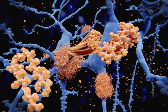 Alzheimer's Breakthrough as Parkinson's Drug Surprise Teases New Treatment