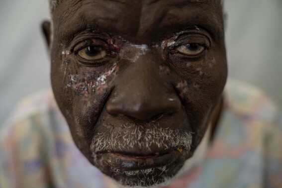 A photographer captures the mpox health crisis in Africa in a closeup