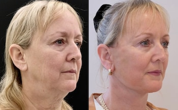 The ‘invisible’ facelift that’s better than fillers