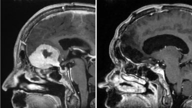 Surgeon removes large brain tumours through patients' eyebrows in 'world first'